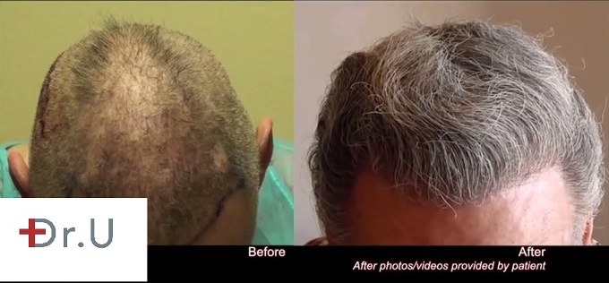 Body Hair Transplantation using 7300 grafts before and after