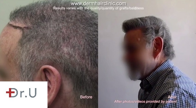 Side View of Hair Repair Results| Beard & Scalp Hair - 7300 Grafts