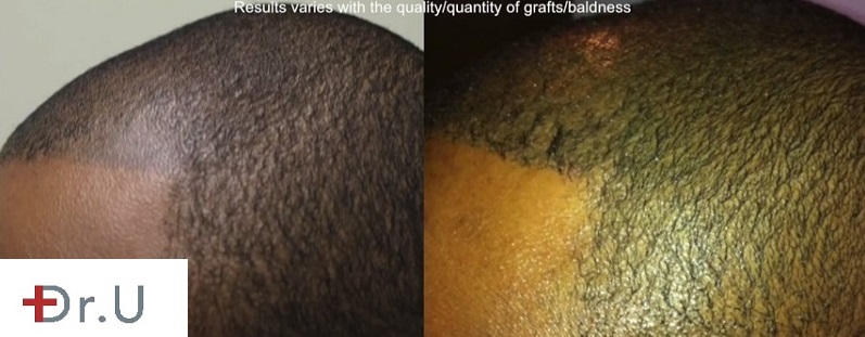Temples and SMP Repair Via Follicular Unit Extraction