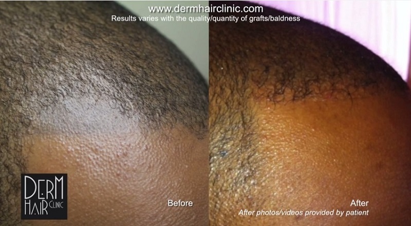 UGraft Hair Transplant repair of Mistakes from choosing Scalp micropigmentation for baldness concealment Option 