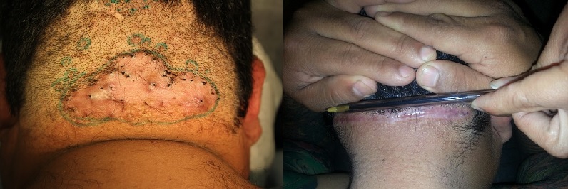 Surgical Removal of AKN Bumps