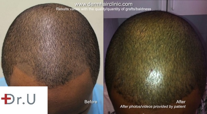 Frontal View of Scalp - Before and After FUE Hair Transplant Repairs Bad Scalp Micropigmentation Frontal View of Scalp - Before and After FUE Hair Transplant Repairs Bad Scalp Micropigmentation