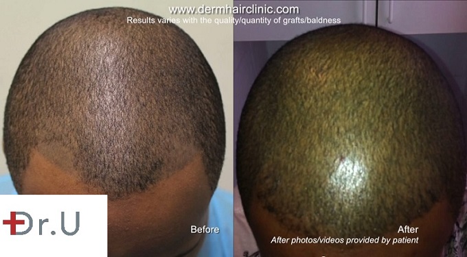 Frontal View of Scalp - Before and After FUE Hair Transplant Repairs Bad Scalp Micropigmentation