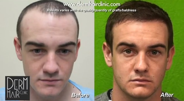 hair restoration through surgery