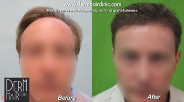Patient With Hairline loss Before and After FUE Surgery