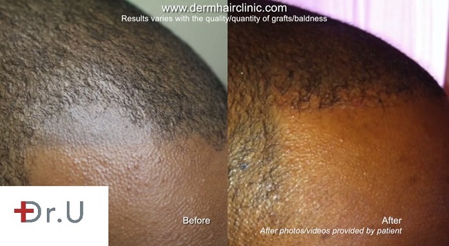 FUE Hair Transplant Repairs Bad Scalp Micropigmentation Before and After