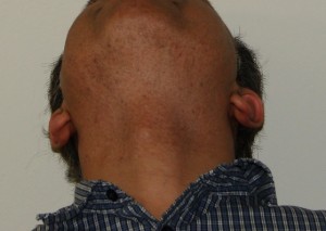 Patient: Indian descent healed beard hair extractions