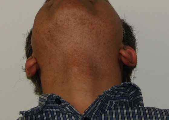 Beard area after over 5000 grafts extraction by UGraft in a person of color