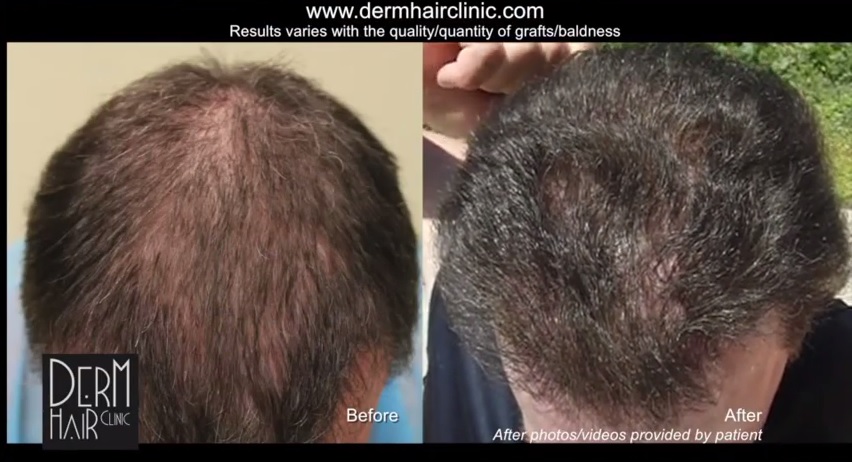 hair restoration results through surgery