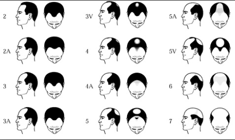 Male Pattern Baldness Hair Loss - Hamilton Norwood