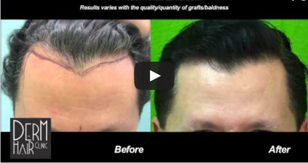 FUE hairline restoration results