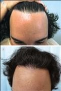 Hairline feathering | Hair transplant | Natural looking hairline