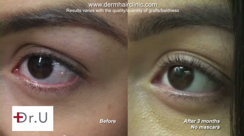 Longer Eyelashes from UGraft eyelash transplant - before and after photos