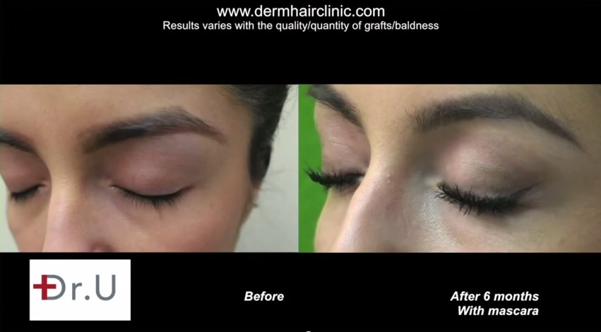 Side View of Eyelash Transplant Results