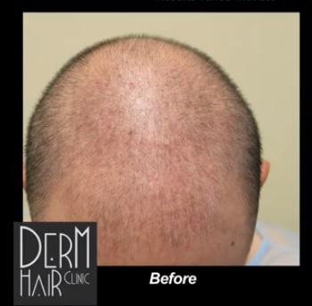 The Minoxidil enzyme sulfotransferase is required for it to work on hair loss 