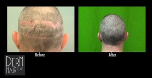 FUE for strip scar repair