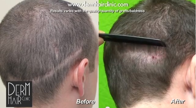 FUE surgery results for hiding strip scar