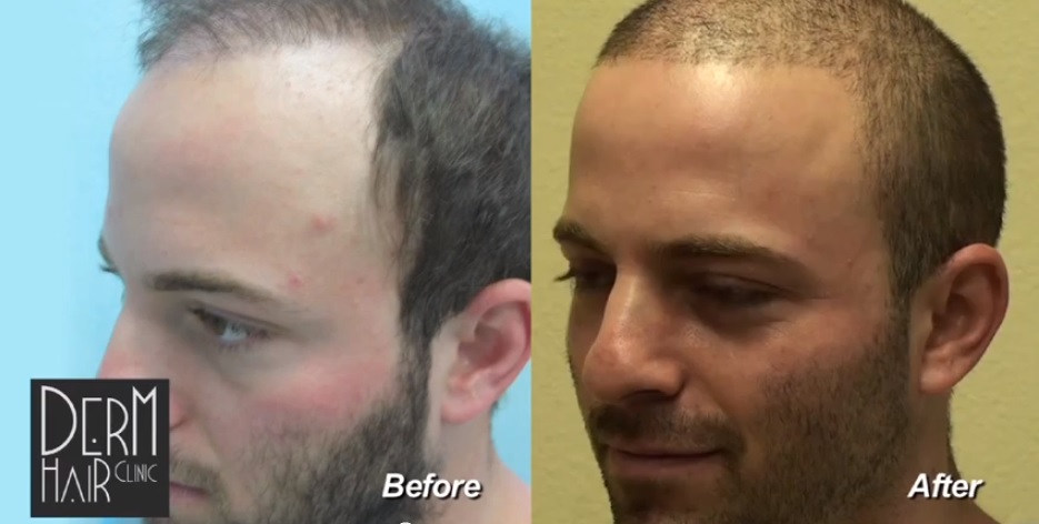 hair transplant using body hair