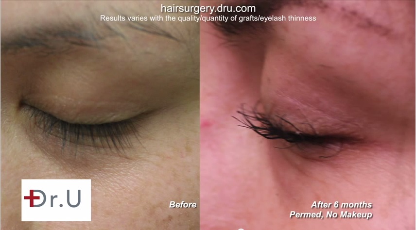 eyelash FUE hair transplantt| No Mascara on Lashes