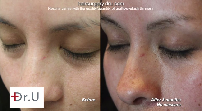 uGraft fue hair restoration for eyelash restoration before and after photos uGraft fue hair restoration for eyelash restoration before and after photos
