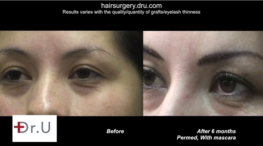 eyelash transplant| before and after surgery for restoration