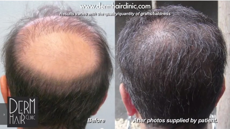 repairing hair transplant mistakes