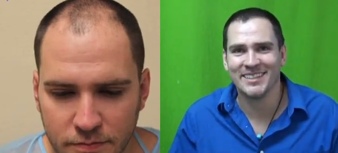 FUE hair transplant| Head Hair Only