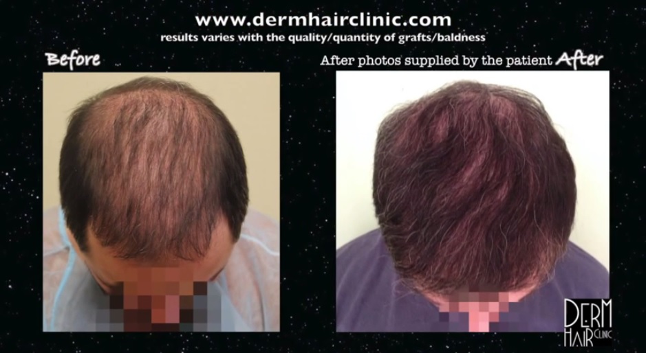 Patient who achieved significantly improved coverage from his body hair transplant procedure.