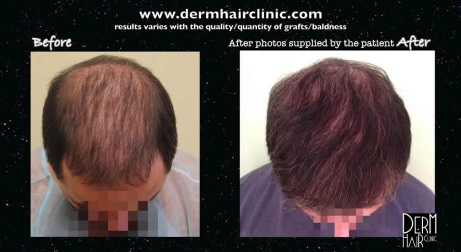 Hair Transplant Alternative Rogaine ?