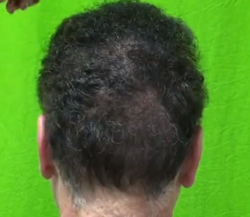 graft number per hair transplant session - what is the maximum?