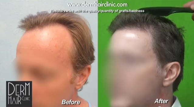 Hairline Restoration Results For Male Pattern Baldness