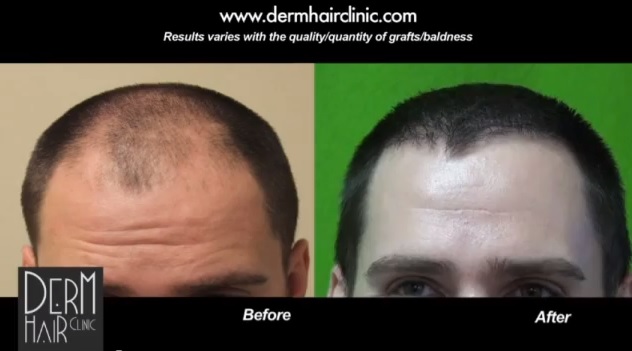 FUE hair transplant patient - Dr. U