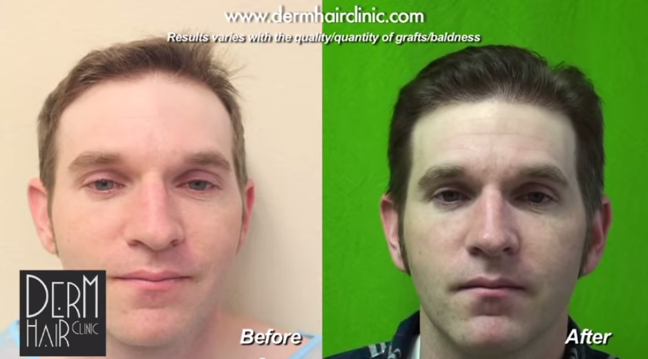 hair transplant facts: quality hair transplant results on patient