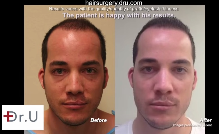 FUE Patient| Before and After FUE hair transplant