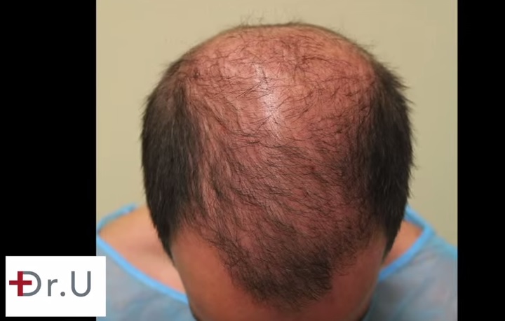 Patient's Frontal Scalp Before UGraft hair transplant