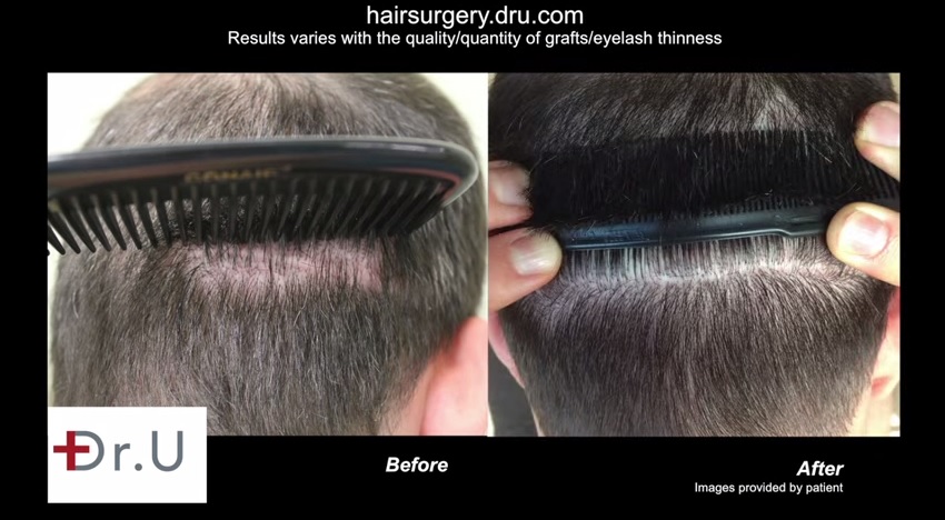 Adding hair density and strip scar repair using 1600 UGrafts