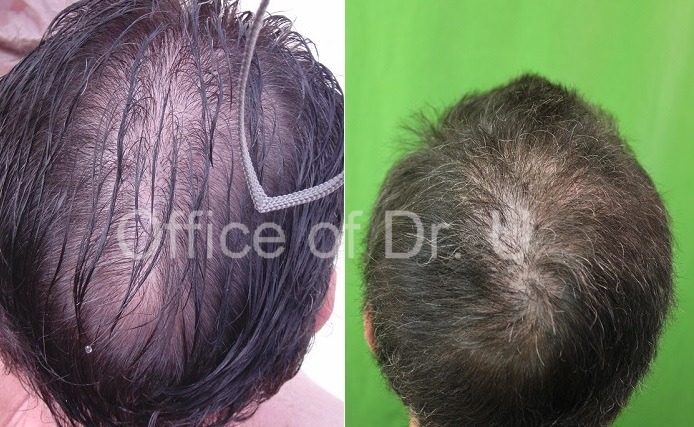 BHT 7000 grafts before and after