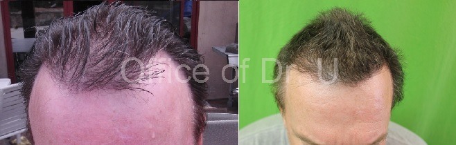 BHT 7000 grafts results