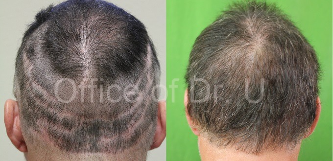 Body hair Transplant 7000 grafts