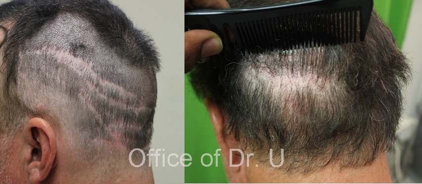 Before and after Body hair Transplant 7000 grafts - strip scar repair