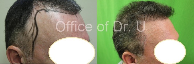 BHT by FUE 7000 grafts before and after temple points