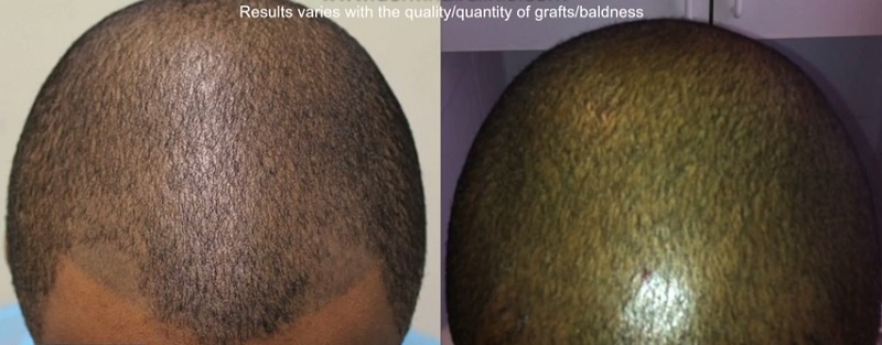 FUE Hair Transplant Repair| Scalp Micropigmentation Results