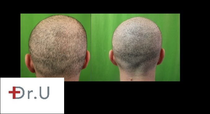 Scalp Micropigmentation Done With Trichopigmentation