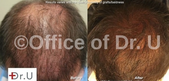 Beard Hair Grafts- Crown, Frontal Scalp & Top| Before and After