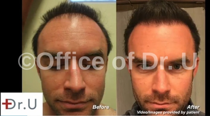 Beard Hair Transplantation|Strip Repair - 4500 Grafts