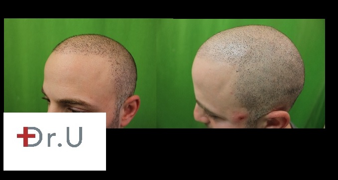 Dr U's non surgical hair restoration patient done using scalp micropigmentation at Los Angeles Dr U's non surgical hair restoration patient done using scalp micropigmentation at Los Angeles