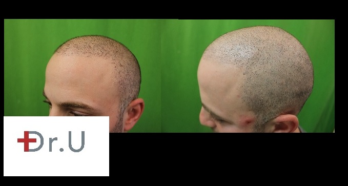 Dr U's non surgical hair restoration patient done using scalp micropigmentation at Los Angeles 