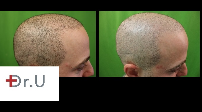 Right Side profile view| Scalp Pigmentation - Trichopigmentation