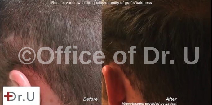 Beard Hair Transplantation| Left Side -Before & After