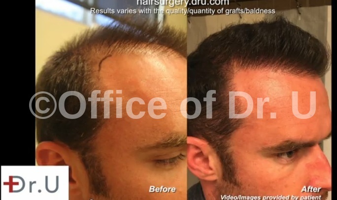 Head And Beard Hair To Head Transplant 4500 Grafts